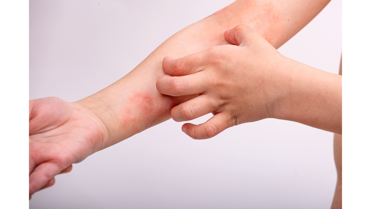 Chronic hand eczema affected skin